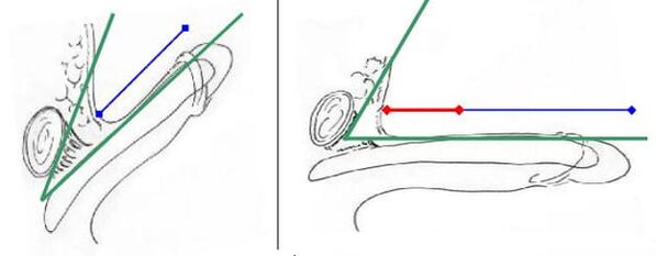 Aumento de la longitud del pene debido a la intersección del ligamento. 