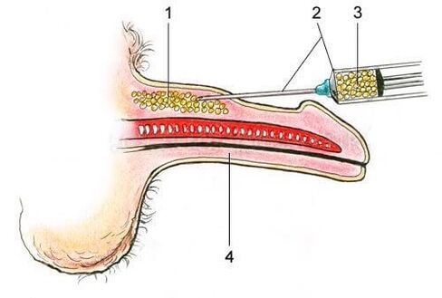 indicaciones para la cirugía de agrandamiento del pene