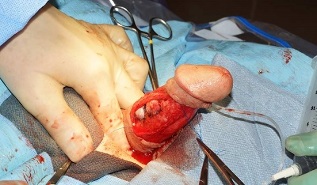 cirugía de alargamiento del pene