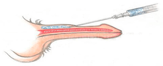 inyección de relleno de pene
