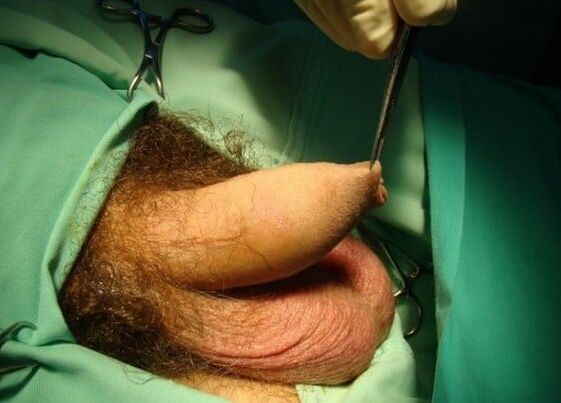 cirugía de alargamiento del pene