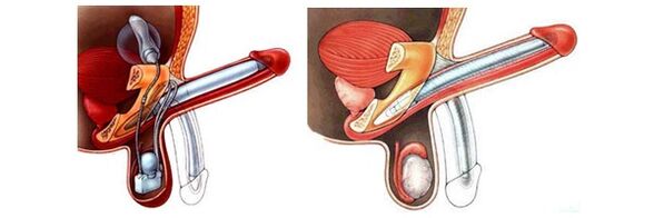 Faloprótesis con prótesis inflable (izquierda) y plástica (derecha)